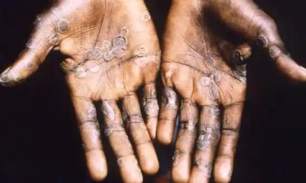 How does monkeypox spread? What the report says amid the global scare.