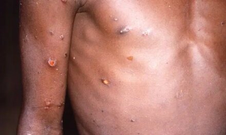 ‘No need to panic’: expert says as WHO records 80 cases of monkeypox in 11 countries