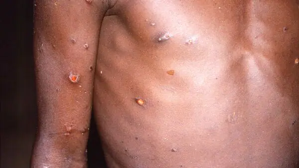 FILE PHOTO: An image created during an investigation into an outbreak of monkeypox, which took place in the Democratic Republic of the Congo, 1996 to 1997, shows the arms and torso of a patient with skin lesions due to monkeypox, in this undated image obtained by Reuters on May 18, 2022. CDC/Brian W.J. Mahy/Handout via REUTERS THIS IMAGE HAS BEEN SUPPLIED BY A THIRD PARTY./File Photo (via REUTERS)